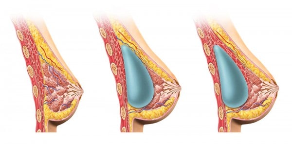 prothèses mammaires-augmentation mammaire