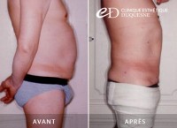 liposuccion douce résultats