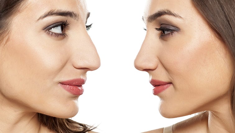 rhinoplastie