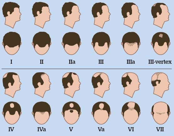 calvitie classification