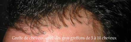 réparation greffe de cheveux