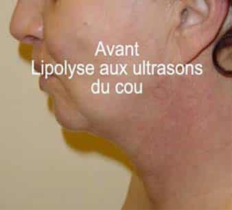 Enlever un double menton, résultat lipolyse aux ultrasons