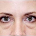 Enlever des poches sous les yeux, blépharoplastie